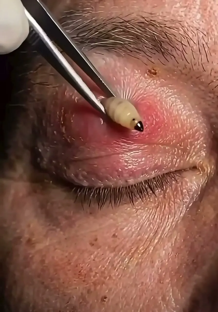 Tweezers gripping the larva as it is drawn out of the swollen skin