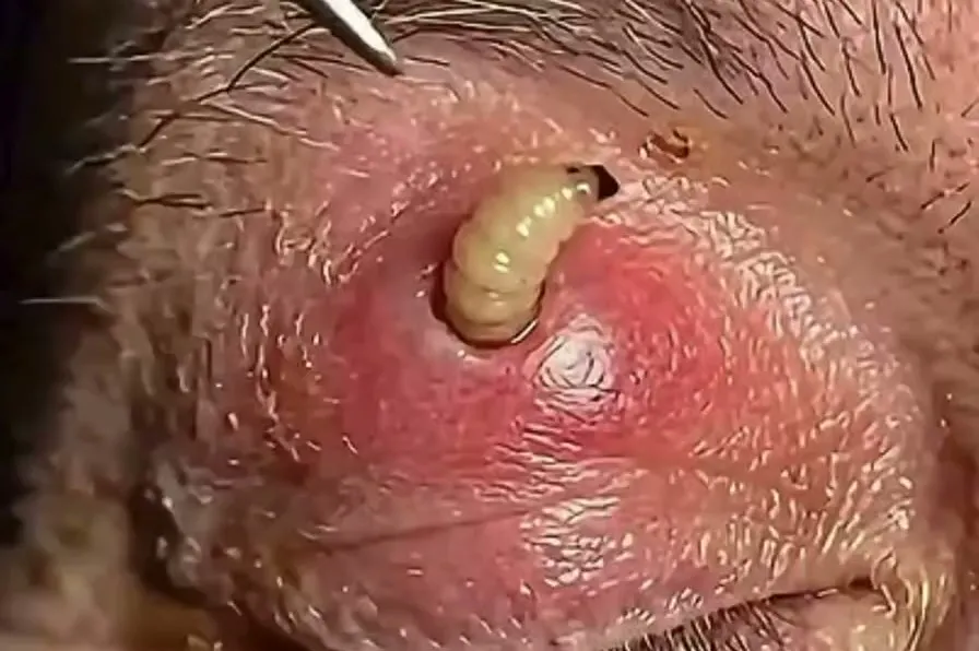Close-up of a pale fly larva emerging from a red, swollen lump above a closed eye